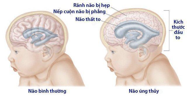 nao-ung-thuy-nguyen-nhan-trieu-chung-chan-doan-va-dieu-tri