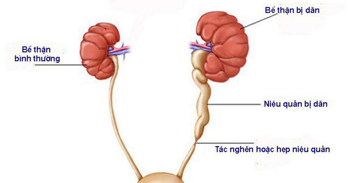 Niệu quản giãn: Nguyên nhân, triệu chứng, chẩn đoán và điều trị -