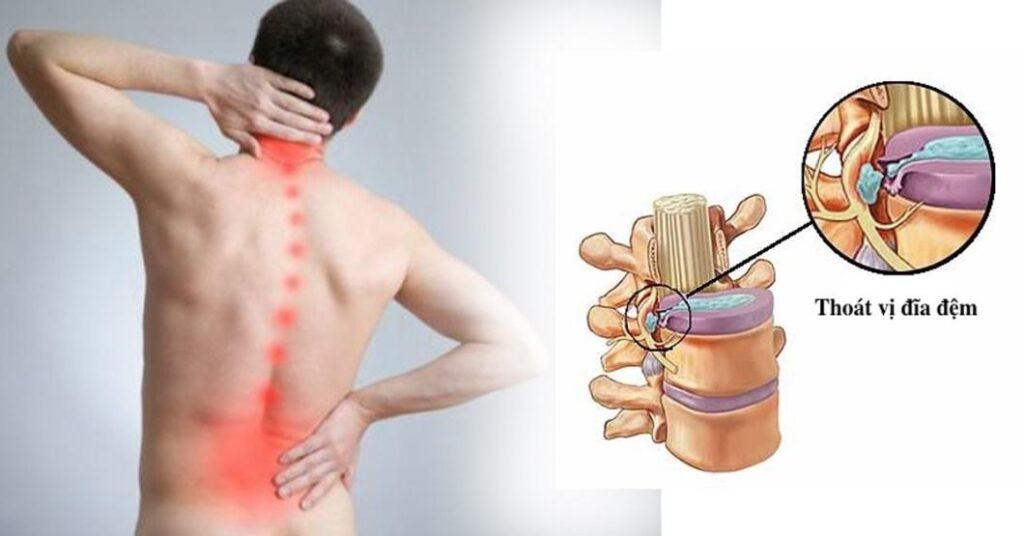 phau-thuat-noi-soi-vi-phau-cot-song-mini-invasive-spine-surgery