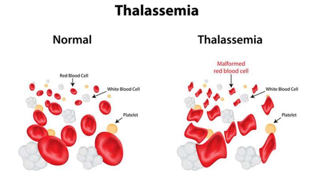 thalassemia-tan-mau-bam-sinh-nguyen-nhan-trieu-chung-chan-doan-va-dieu-tri