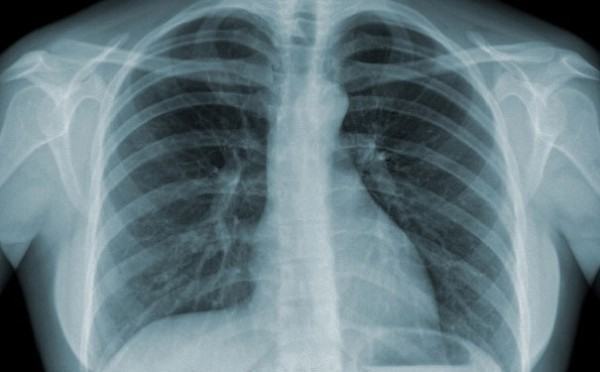 Chụp X - quang phổi