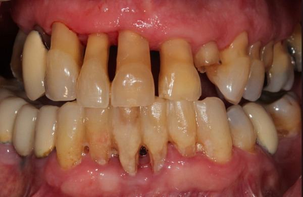 Bệnh răng miệng ảnh hưởng đến sức khỏe và thẩm mỹ