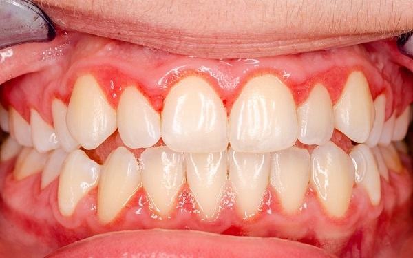 Viêm lợi là bệnh răng miệng phổ biến hiện nay
