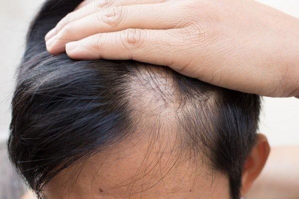Rụng tóc do bệnh lý ở nam giới