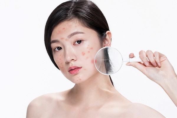Cách chăm sóc da mặt mụn hiệu quả