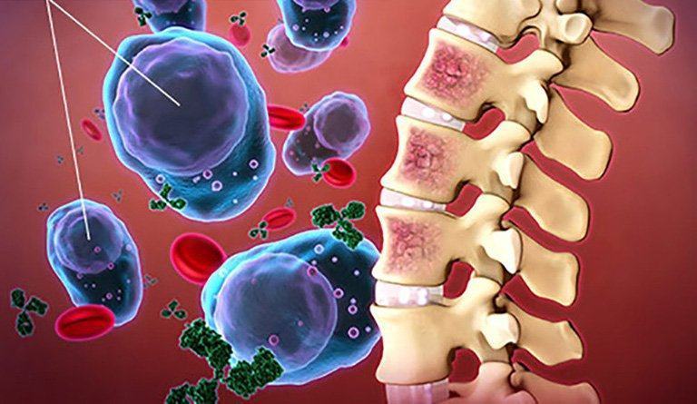 Viêm tủy xương: Nguyên nhân, triệu chứng, chẩn đoán và điều trị