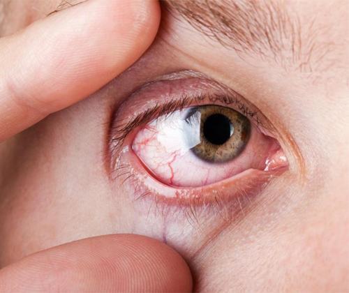 Triệu chứng đau mắt hột và những điều cần biết