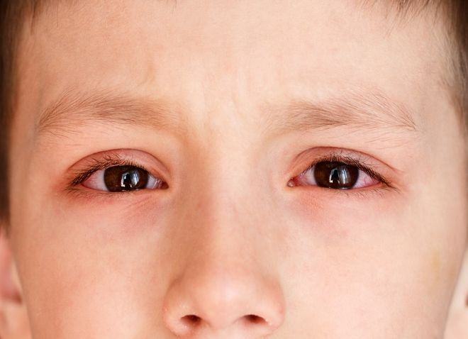 Bệnh đau mắt hột ở trẻ em và những điều phụ huynh cần chú ý