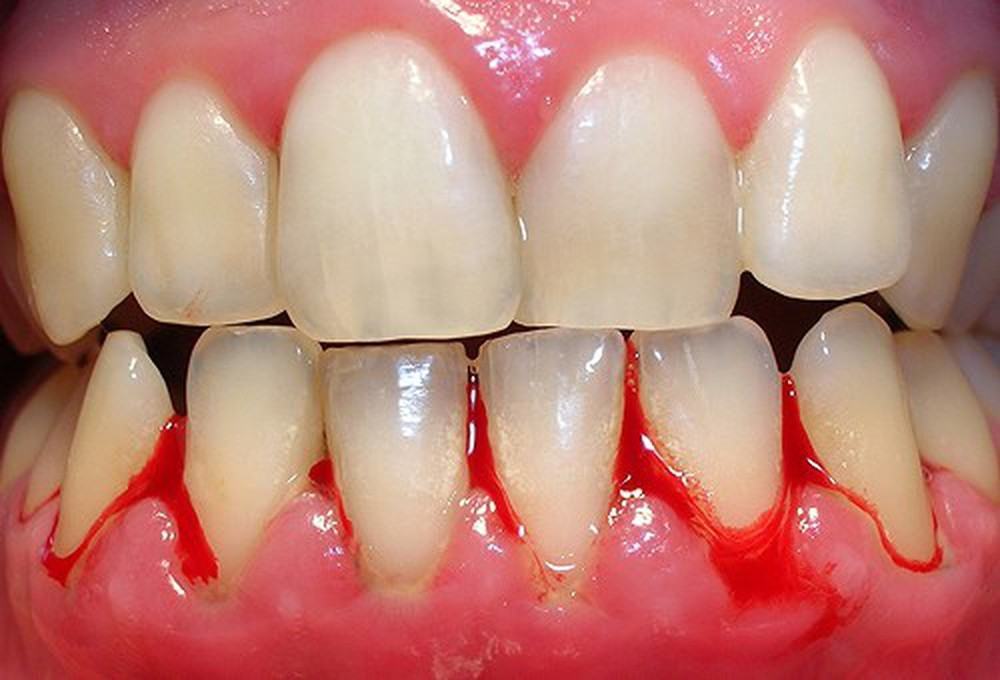 Bệnh gì gây hôi miệng và chảy máu chân răng?