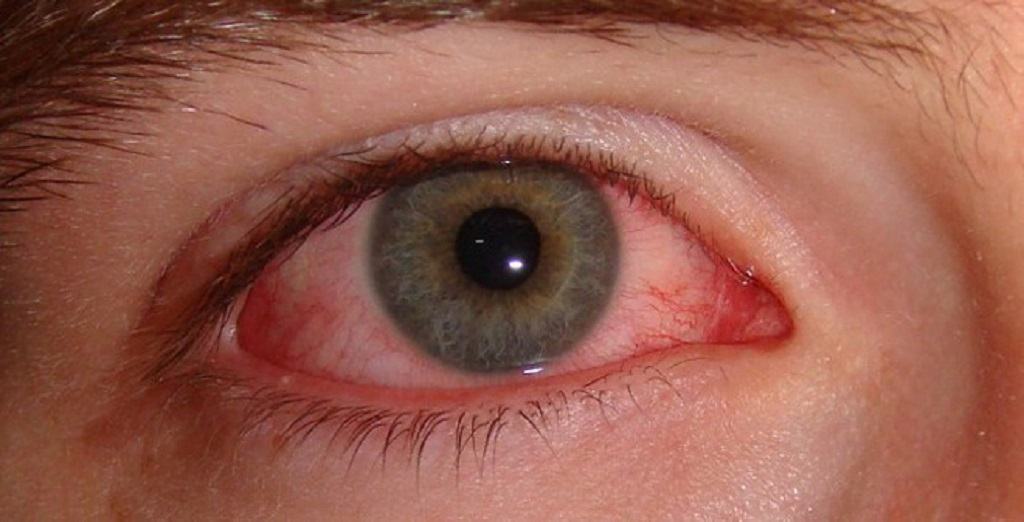 Loạt hình ảnh về bệnh đau mắt hột