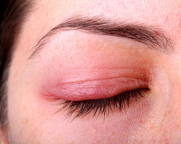 Bị đau mắt đỏ và sưng húp chữa như thế nào?