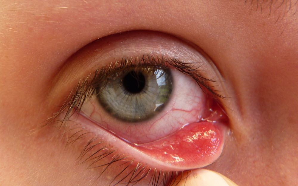 Cách xử lý và phòng tránh chứng đau mắt đỏ sưng tấy