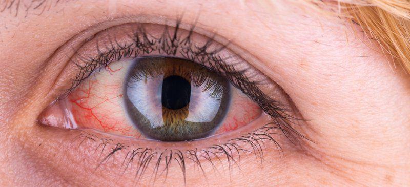 Dấu hiệu của bệnh đau mắt đỏ viêm kết mạc đã chuyển nặng