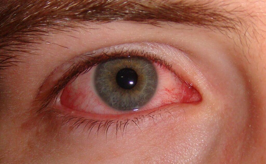 Đau mắt đỏ dấu hiệu để nhận biết chính xác nhất