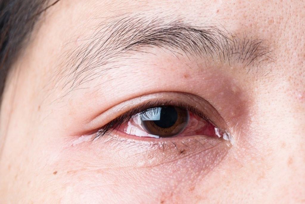 Đau mắt đỏ có gây sốt không?