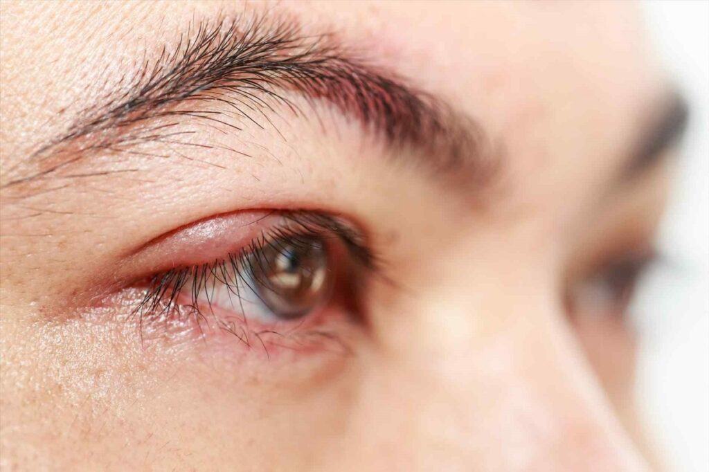 Phải làm sao để xử lý triệu chứng đau mắt đỏ bị sưng gây khó chịu?