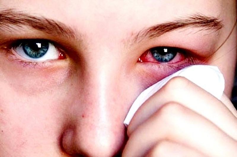 Phòng ngừa bệnh đau mắt đỏ bằng cách nào?