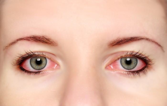 Phương pháp giúp hạn chế tình trạng đau mắt đỏ tái phát nhiều lần?