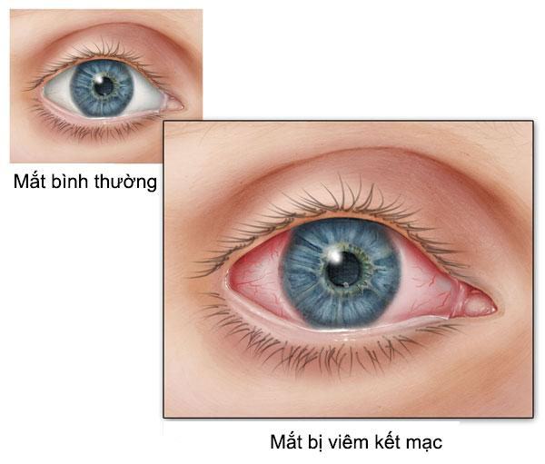 Bạn có biết phải làm gì khi bị đau mắt đỏ không?