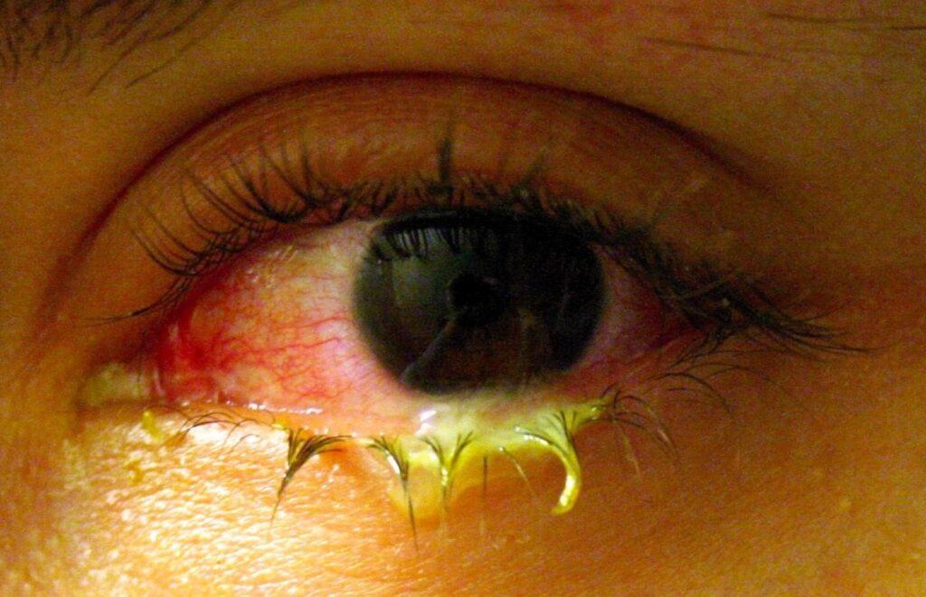 Cần làm gì để tránh lây đau mắt đỏ?