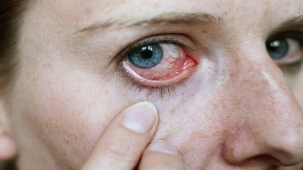 Dù có dịch hay không cũng cần phòng lây đau mắt đỏ bằng các cách sau