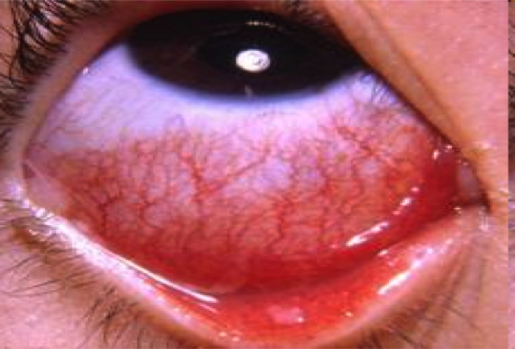 Nên kiêng gì khi bị đau mắt đỏ?