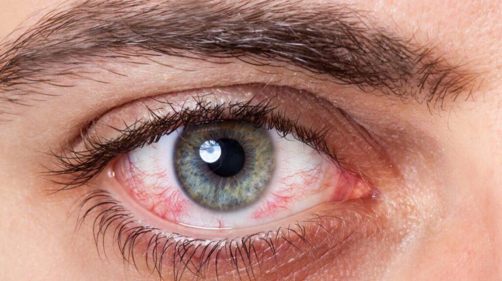 Nguyên nhân đau mắt đỏ và cách chữa trị như thế nào?
