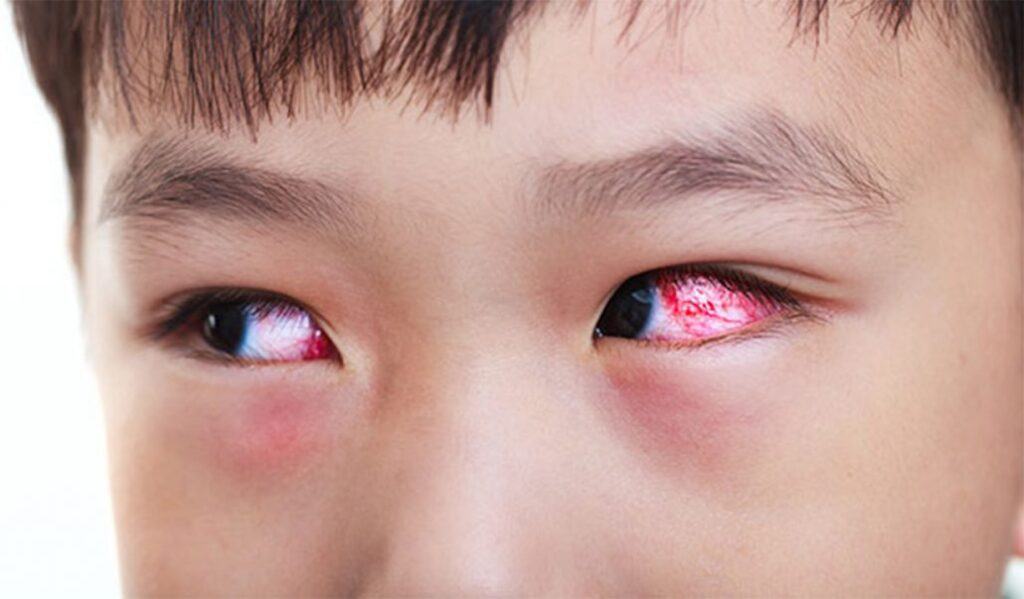 Nguyên nhân đau mắt đỏ và những triệu chứng thường gặp