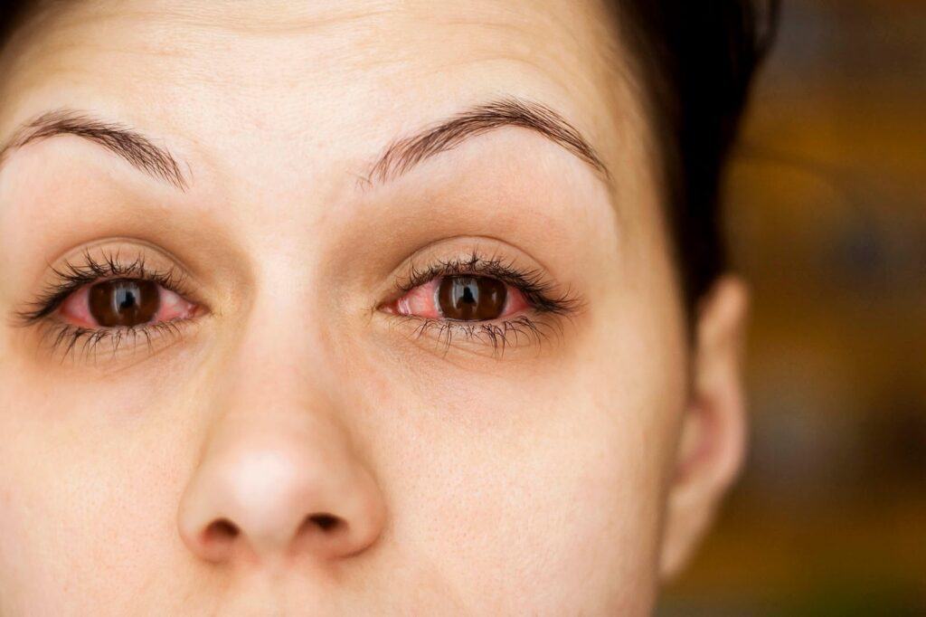 Phương pháp chữa đau mắt đỏ nhanh nhất, đơn giản nhất