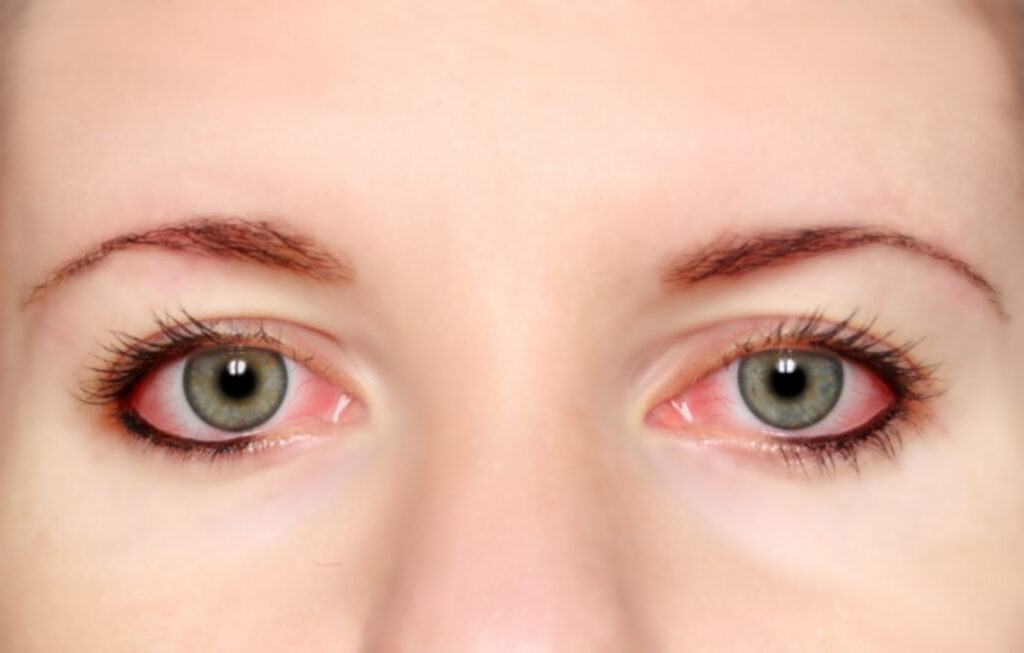 Tại sao lại có tình trạng đau mắt đỏ bị mờ mắt và cách điều trị ra sao