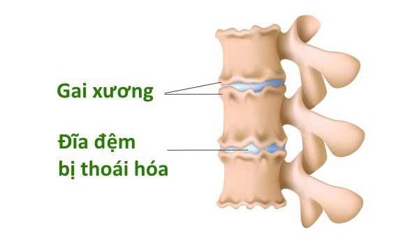 ban-co-biet-gi-ve-co-che-hinh-thanh-cac-xuong-gai-cot-song-trong-co-the